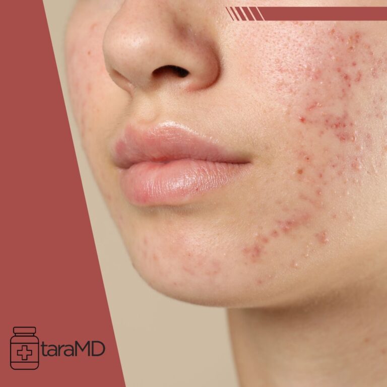 acne